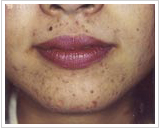 20代女性 2ヶ月後