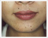 20代女性 4ヶ月後