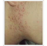 20代女性 1ヶ月後