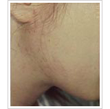 20代女性 6ヶ月後