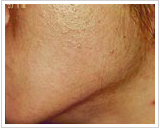 20代女性 11ヶ月後