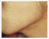 20代女性 13ヶ月後