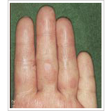 20代女性 13日後