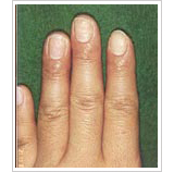 20代女性 13日後