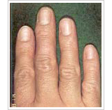 30代女性 1ヶ月後