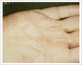 30代女性 13日後