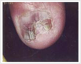 70代女性 3ヶ月後