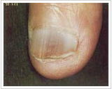 70代女性 8ヶ月後