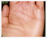 30代女性 13日後