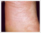 30代女性 13日後