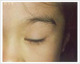 6歳女性 11ヶ月後