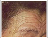 80代 女性6ヶ月後