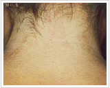 70代女性 6ヶ月後