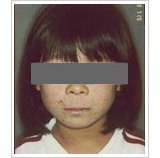 5歳女性 初診